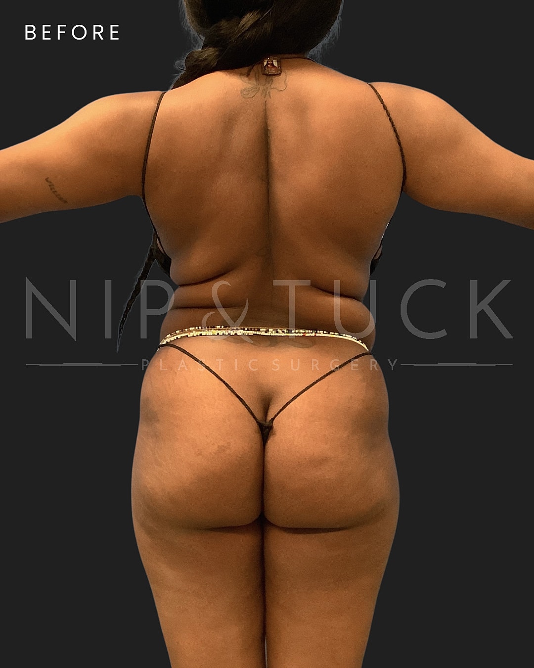 Liposuction Before & After