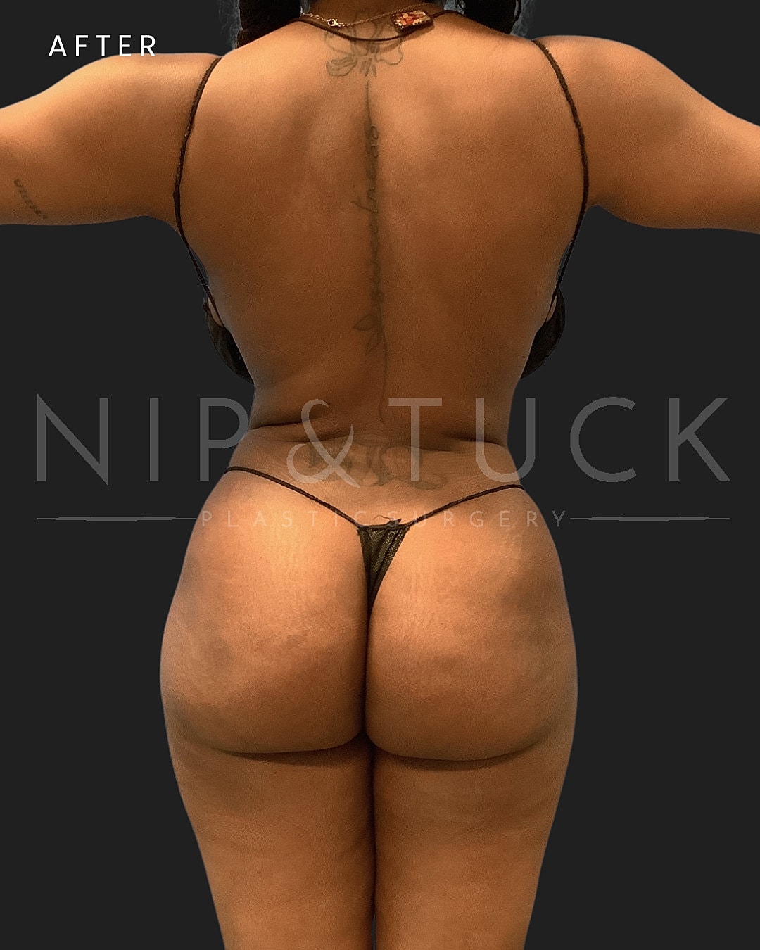 Liposuction Before & After