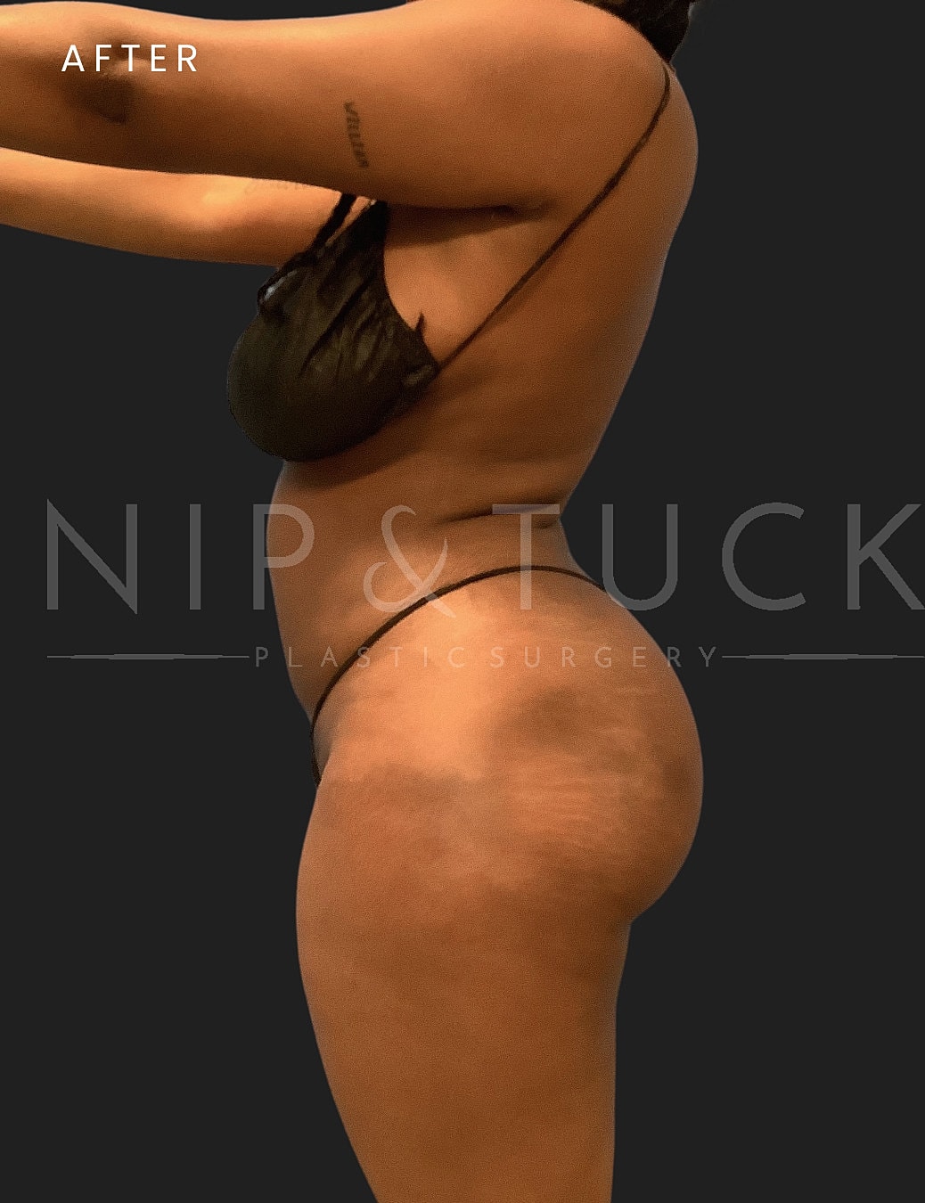 Liposuction Before & After