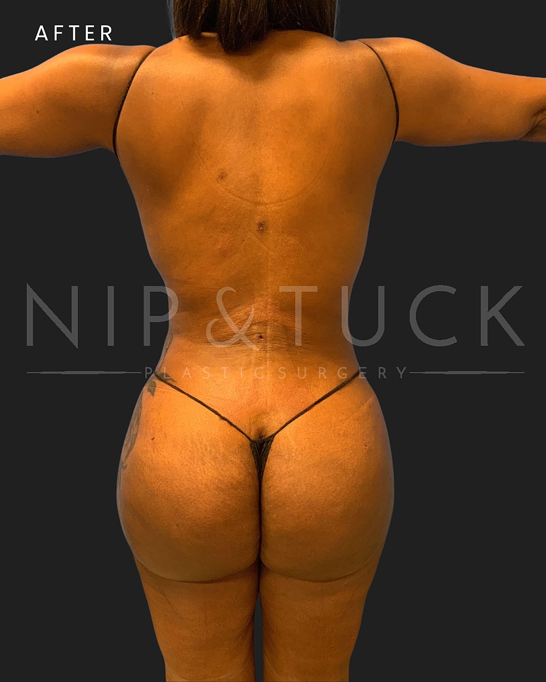 Liposuction Before & After