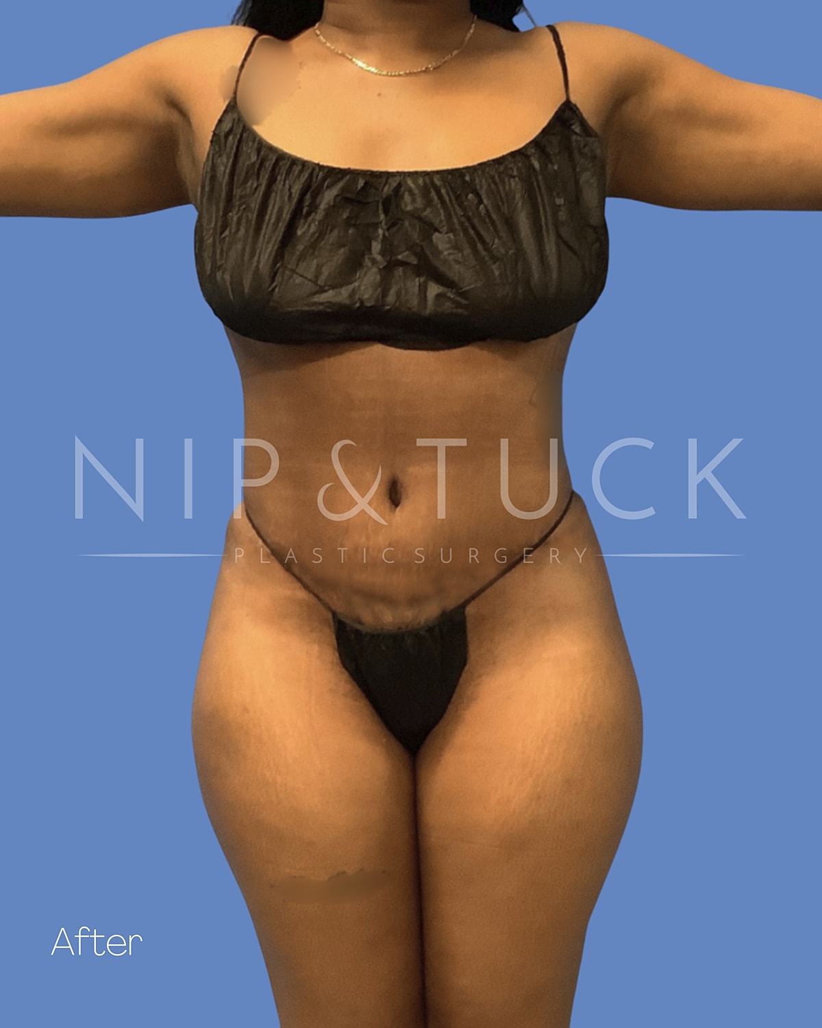 Liposuction Before & After