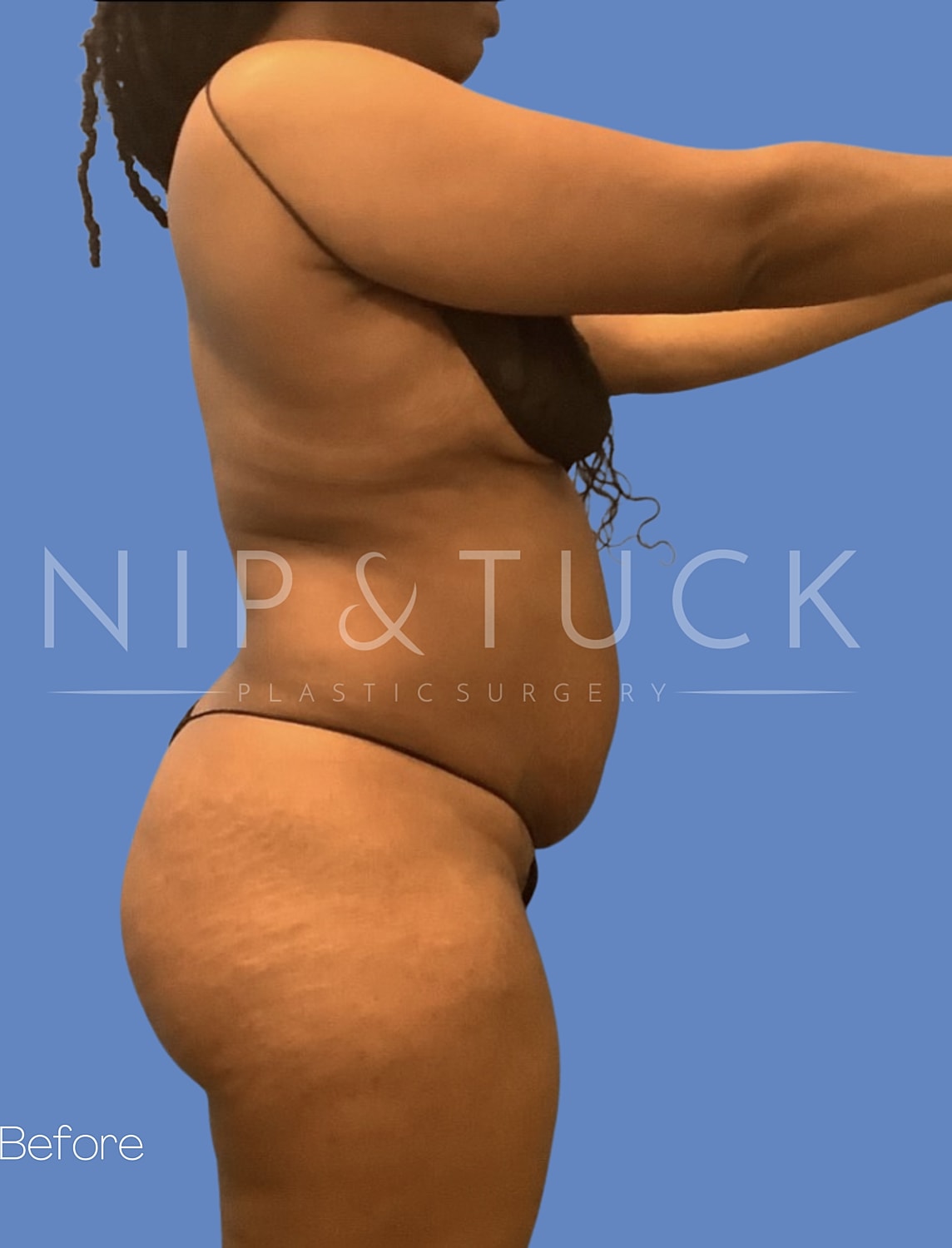 Liposuction Before & After