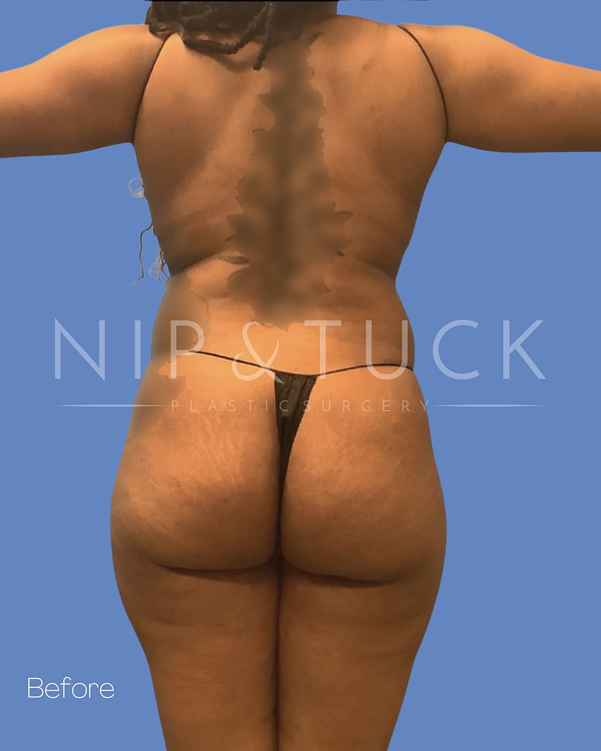 Liposuction Before & After