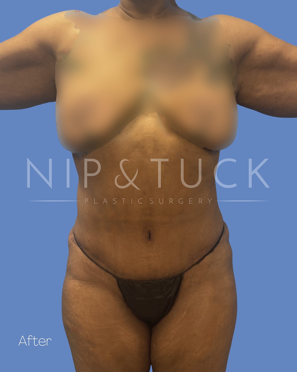 Liposuction Before & After