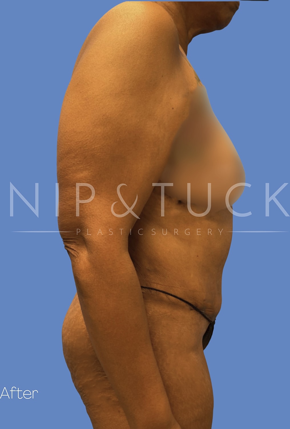 Liposuction Before & After