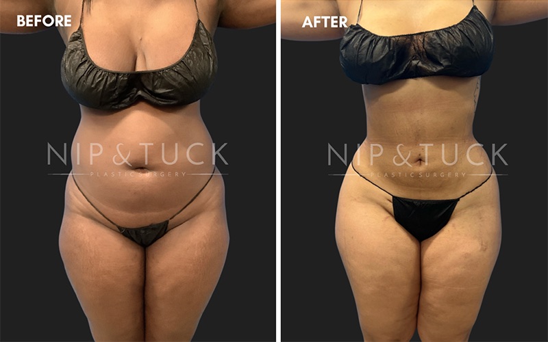 Before and after abdominal liposuction at Nip & Tuck Plastic Surgery