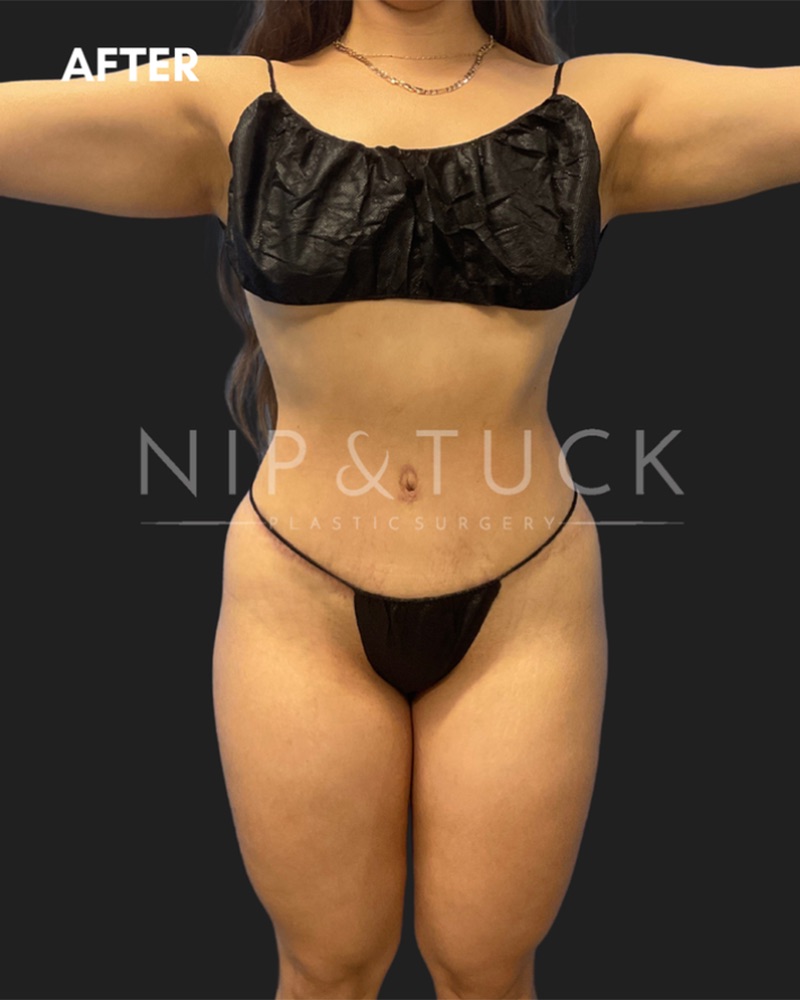 Tummy tuck patient at 8 weeks post-op with flat abdomen