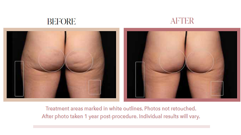 What to Know About Aveli: The Latest Breakthrough in Cellulite Treatment