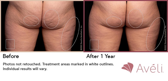 Aveli Cellulite Treatment Atlanta, GA