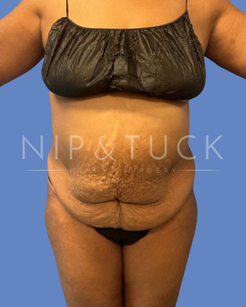 Abdominoplasty Surgery Atlanta, Tummy Tuck