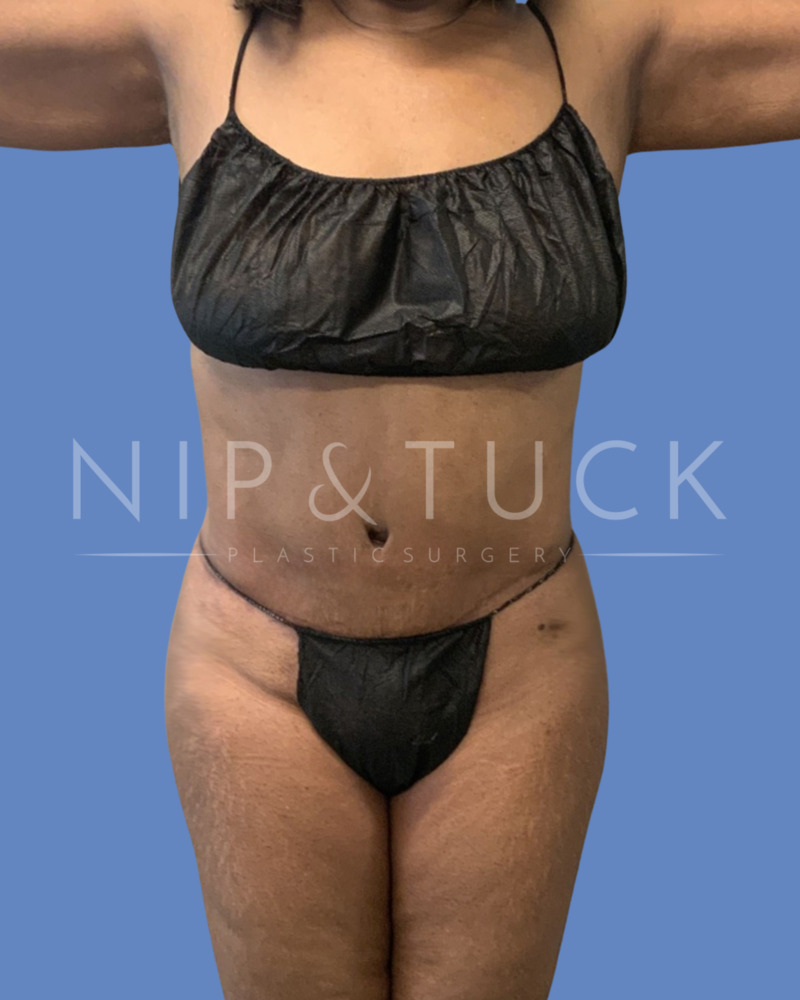 Abdominoplasty Surgery Atlanta, Tummy Tuck